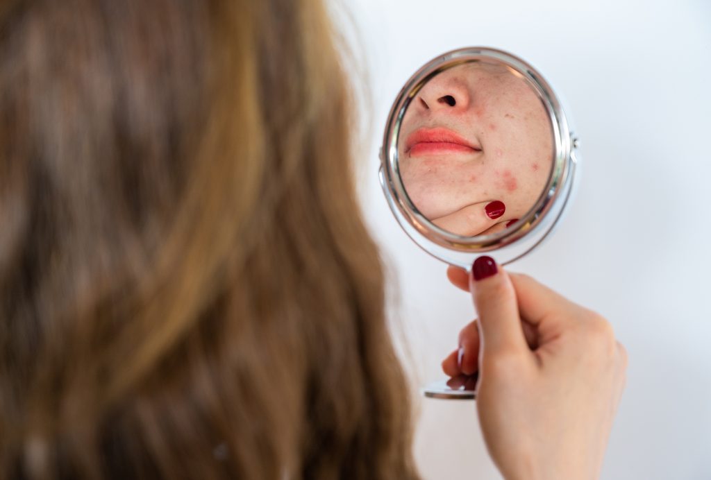 Cropped Shot Of Woman Worry About Her Face When She Saw The Problem Of Acne Occur On Face By A Mini Mirror 